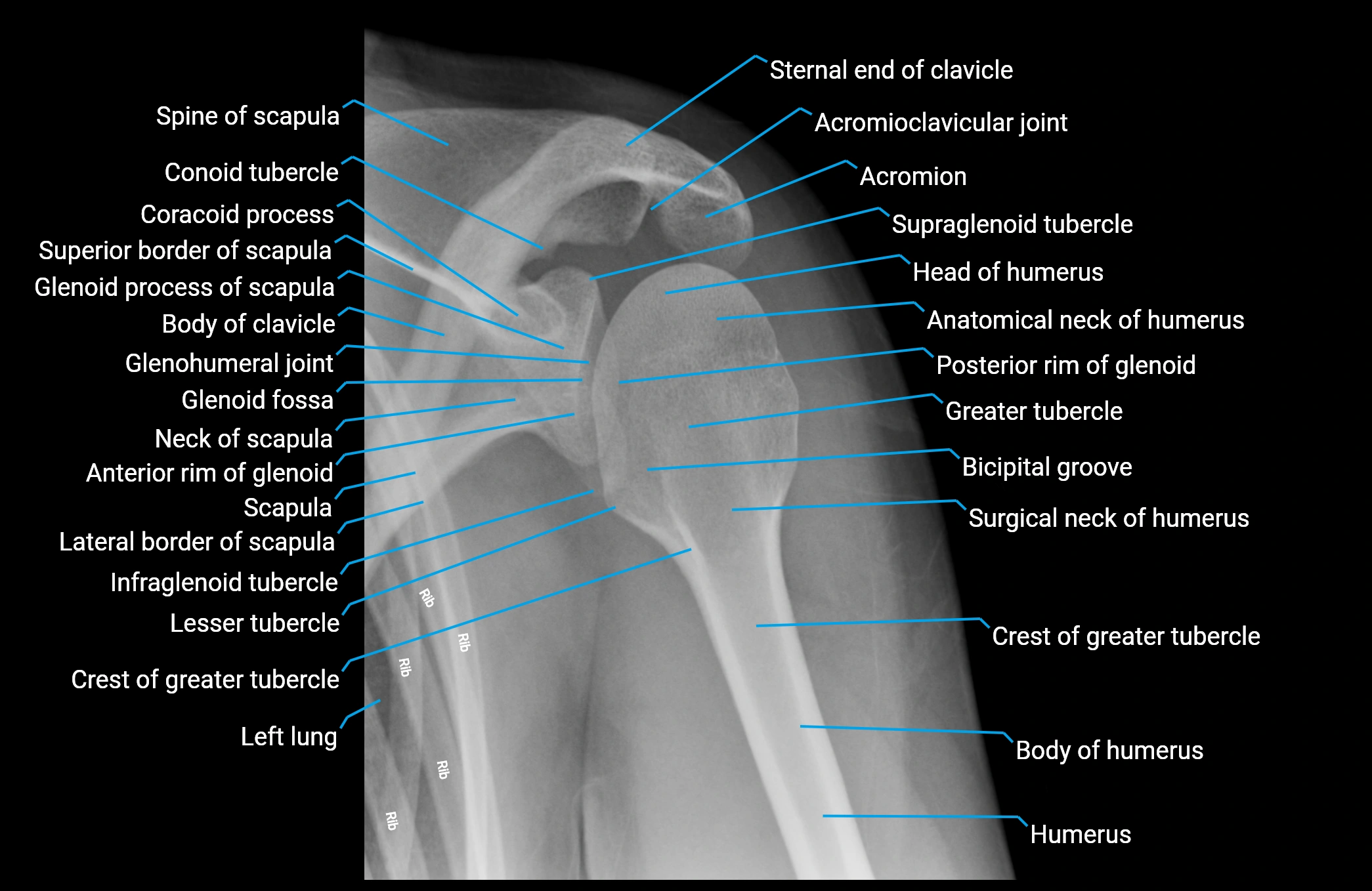 X Ray shoulder apical oblique anatomy labelled imaging.webp